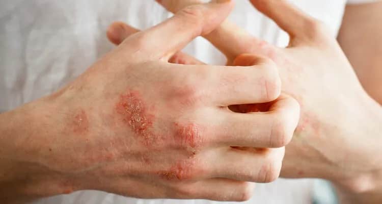 Alergia na gluten objawy skórne – jak je rozpoznać i leczyć