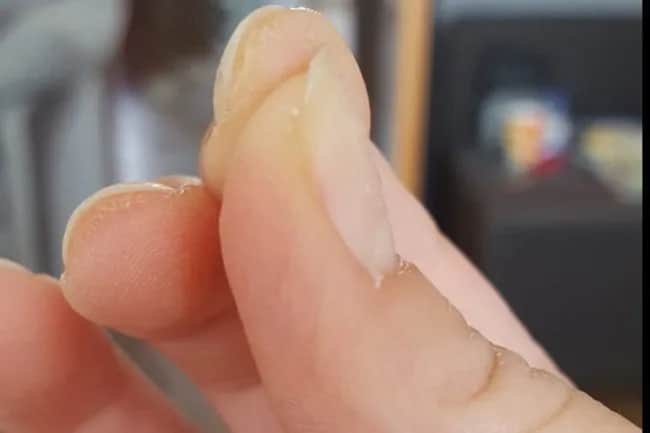 Alergia na hybrydy objawy: jak rozpoznać niebezpieczne reakcje skórne