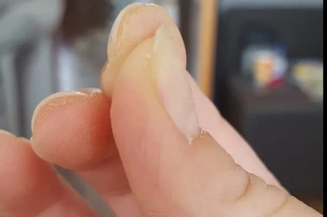 Alergia na hybrydy objawy: jak rozpoznać niebezpieczne reakcje skórne