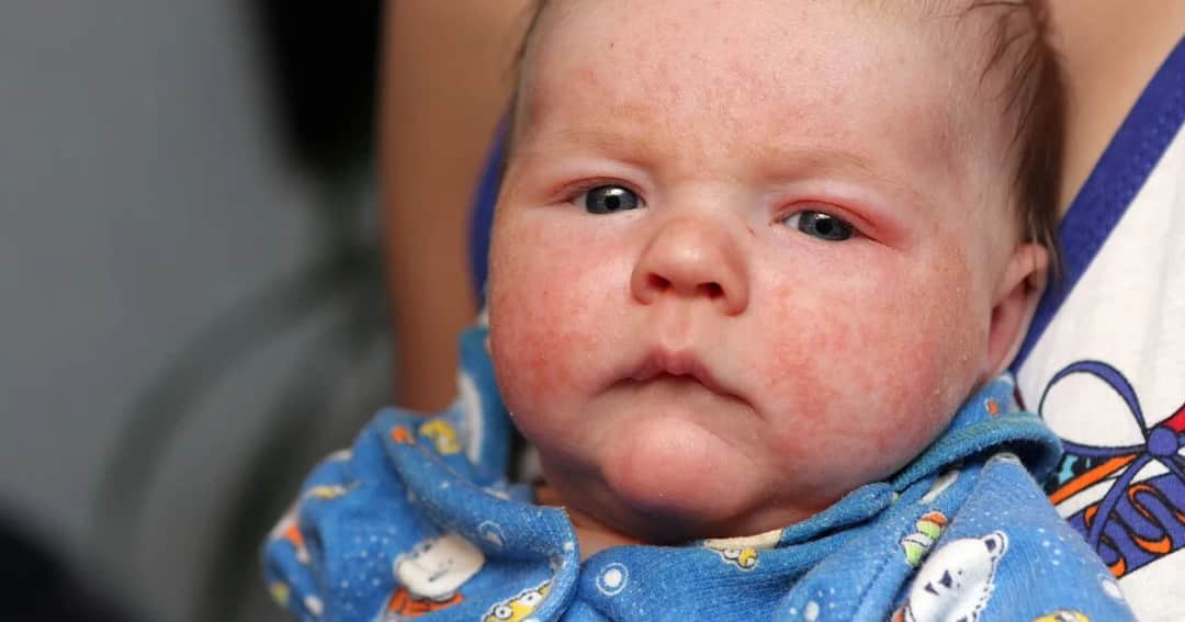 Alergia na nabiał u niemowląt objawy, które mogą zaniepokoić rodziców