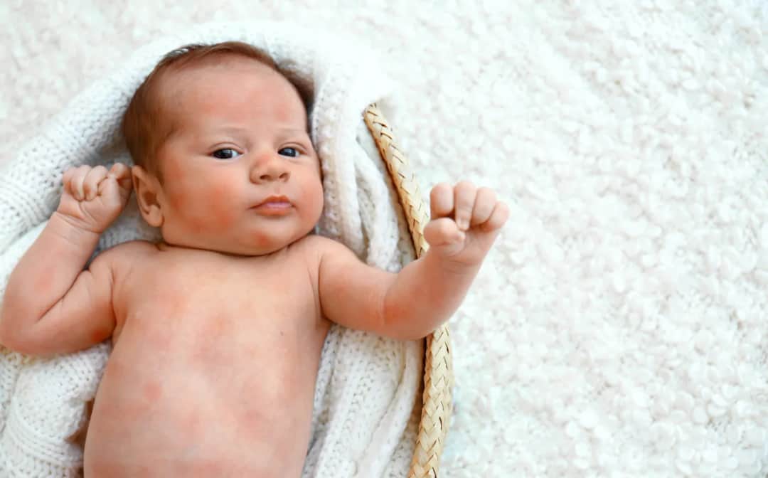 Jak wygląda alergia pokarmowa u niemowląt - objawy, które musisz znać